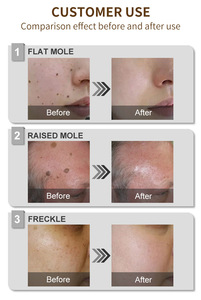 Masajeador Facial de Iones Fríos para Uso Doméstico -5 ℃   Instrumento de Belleza con Efecto Hielo para Reducir Poros, Aumentar la Absorción, Aliviar el Enrojecimiento e Iluminar la Piel - Product Image 6