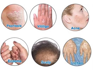 Cabine de photothérapie à bande étroite UVB à KN-4001AB de noyau 40 pièces Tube cabine de traitement UVB pour équipement de physiothérapie du psoriasis - Product Image 6