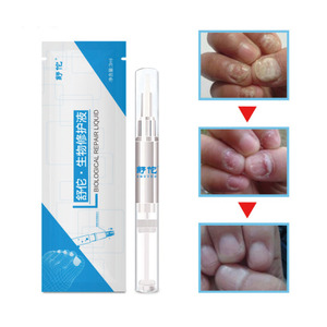 Buona Efficace A Base di Erbe Punta Infezione Onicomicosi Paronychia Nail FungusTreatment Penna Per Anti Fungine Delle Unghie - Product Image 2