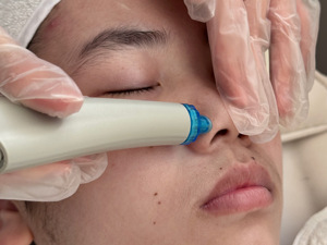 Appareil de nettoyage du visage Hydralift EP, machine de peeling aquatique, dermabrasion, rajeunissement, aspiration, HIEMS, soin de la peau - Product Image 5