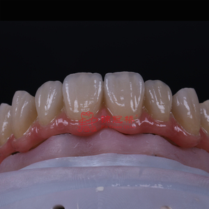 Implante Dental Apoyado Dentaduras Retentivas Aspecto Natural con <span class=keywords><strong>Precio</strong></span> Competitivo y Laboratorio de Alta Calidad China - Product Image 3