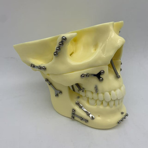 <span class=keywords><strong>Fracture</strong></span> osseuse fixe avec plaque de titane et modèle de <span class=keywords><strong>crâne</strong></span> dentaire Ortho Implant - Product Image 1
