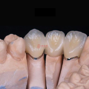 Prezioso e <span class=keywords><strong>Non</strong></span> prezioso metallo dentale Co-Cr lega corona e ponte in alta qualità e buona estetica dentiera denti - Product Image 3