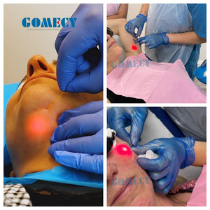 Penghapusan Lemak Liposuction Endolaser 980 Diode Laser Pengobatan Jamur Kuku, Varises, dan Pembuluh Darah - Product Image 2