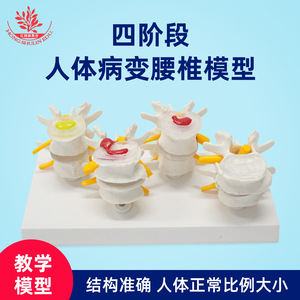El modelo de columna vertebral humana FRT032 utiliza una vértebra lumbar normal y un modelo de lesión de hernia de disco intervertebral lumbar de 4 etapas. - Product Image 5