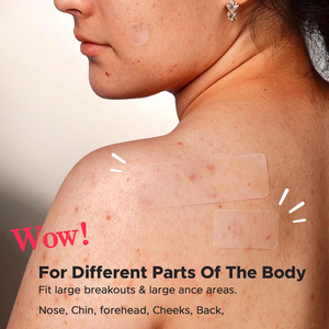 Các bản vá lỗi Hydrocolloid 5x10 mụn vá 96 300 đếm mụn nhà sản xuất Hydrocolloid vá - Product Image 5