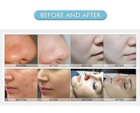 Máquina de Belleza Facial Hydro Agua Peel Oxygen Jet 2 en 1, Dispositivo de Limpieza Facial Hydra