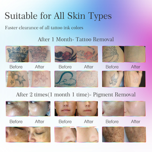 Mesin Penghilang Pigmen dan Tato <span class=keywords><strong>Laser</strong></span> Pico 532 755 1320 1064 Nd <span class=keywords><strong>Yag</strong></span> - Product Image 6