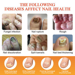 Kanyehb การรักษาเชื้อรา/ยาขัดเล็บกำจัดสีเทาขนข้ามชายแดนการค้าต่างประเทศ - Product Image 2