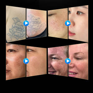 เครื่องกำจัดรอยสักด้วยเลเซอร์ Picosecond รุ่นปี 2026 ขายดี พร้อ<span class=keywords><strong>ม</strong></span>เทคโนโลยี Picolaser 1064nm 532nm แบบ Q-Switched Nd Yag <span class=keywords><strong>ราคา</strong></span>พิเศษ - Product Image 4