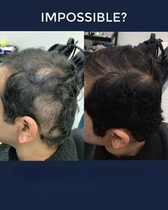 Terapi <span class=keywords><strong>Laser</strong></span> <span class=keywords><strong>Level</strong></span> rendah LLLT Diode 650nm pertumbuhan kembali perawatan rambut rontok dengan penganalisis rambut mesin penumbuh rambut <span class=keywords><strong>Laser</strong></span> tumbuh lebih cepat - Product Image 5