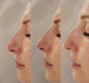 Hilos Tensores Faciales y Corporales L Korea al por Mayor OEM DDP CE PDO, Hilos Cog 3-1L 19G 60mm para Entrenamiento en Academias de Estética Médica - Product Image 3