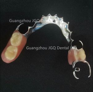 กรอบโลหะฟันปลอมบางส่วนที่ถอดออกได้ได้รับความนิยมมีความเสถียรและการเก็บรักษา (โคบอลต์และโครเมี่ยม) - Product Image 4