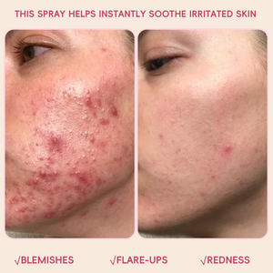 Private Label Professional Care pH Balanced Barrier Repair Anti inflammation Acne Removal Hypochlorous Acid Sensitive Skin Toner - Product Image 4