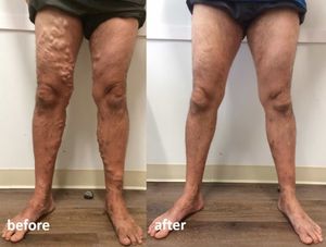 New Design Laser 980+1470nm EVLT Laser Remove <strong>Varicose</strong> <strong>Veins</strong> 980nm 1470nm Vascular Laser Machine - Product Image 5