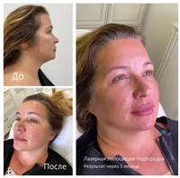 Machine amincissante de corps de lipolyse Non invasive 980nm, perte de poids, élimination des graisses, vaser, lipo, laser, liposuccion