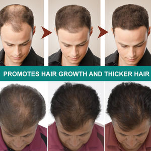 Tratamiento de pérdida de cabello tópico de espuma para mujeres una vez al día para mujeres Regrow Fuller más grueso sin perfume Suministro de 4 meses Spray para el crecimiento del cabello - Product Image 4