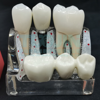 Modèle d'analyse dentaire 4 fois agrandi pour implants, couronnes, bridges, démonstration, modèle amovible, modèle d'enseignement et de formation pour dentistes