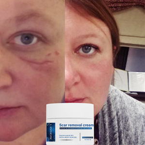 Tratamiento de cicatrices de fórmula avanzada que reduce la apariencia de cicatrices antiguas y nuevas, producto <span class=keywords><strong>para</strong></span> cirugía, lesiones, quemaduras, crema <span class=keywords><strong>para</strong></span> eliminar cicatrices de acné - Product Image 6