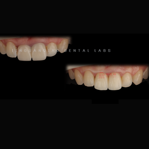 Fournitures pour prothèses dentaires Produits dentaires Placage en porcelaine Restauration de prothèses fixes <span class=keywords><strong>Sourire</strong></span> <span class=keywords><strong>parfait</strong></span> - Product Image 5