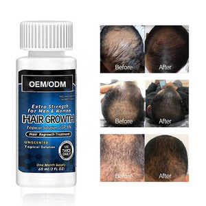 Suero <span class=keywords><strong>para</strong></span> <span class=keywords><strong>el</strong></span> Crecimiento del Cabello, Tratamiento Capilar Orgánico Personalizado OEM de 60 ml, 5% de Aceite <span class=keywords><strong>para</strong></span> <span class=keywords><strong>el</strong></span> Crecimiento del Cabello, Agente Nutritivo y Engrosador, Previene <span class=keywords><strong>la</strong></span> Caída del Cabello - Product Image 2
