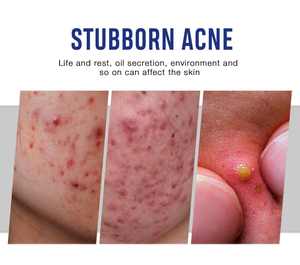 Crema QBEKA para el Tratamiento del Acné, Reafirmante, Elimina Cicatrices de Acné, Antienvejecimiento, Reduce el Enrojecimiento Facial, Mejora la Reducción de Poros, Crema Facial - Product Image 2