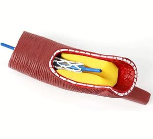 Modelo de <span class=keywords><strong>stent</strong></span> vascular humano KyrenMed, soporte de bloqueo de vasos sanguíneos cardiovasculares de arteria coronaria, modelo de bloqueo de vasos sanguíneos - Product Image 3