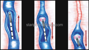 Evlt 1470 Diode Endolifting <span class=keywords><strong>Laser</strong></span> <span class=keywords><strong>Hemorrhoid</strong></span> Facial Slimming Portable Desktop Varicose Veins <span class=keywords><strong>Treatment</strong></span> 2 <span class=keywords><strong>Laser</strong></span> Beauty Equipment. - Product Image 4