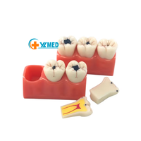 Modelo anatómico de enfermedad de caries dental con resina de aumento 3x modelo de cabeza de ciencia médica de PVC para escuelas entrenamiento de hospitales