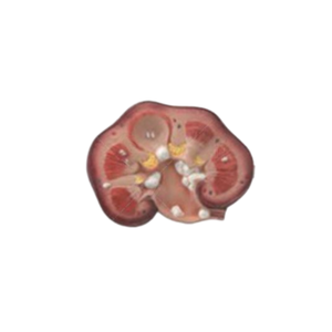 Modèle pédagogique de calcul rénal pour l'enseignement en urologie - Product Image 2