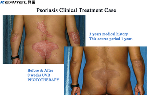 Lámpara UVB UVA para Hospital, Cabina de Fototerapia UV de Banda Estrecha 311nm, Tratamiento para Vitiligo, Psoriasis y Eccema en Clínicas Dermatológicas - Product Image 6