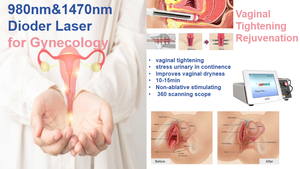Láser de Diodo Portátil Profesional para <span class=keywords><strong>Tratamiento</strong></span> Ginecológico LVR 980nm/1470nm para Rejuvenecimiento y Tensado Vaginal, Eliminación de Arañas Vasculares - Product Image 2