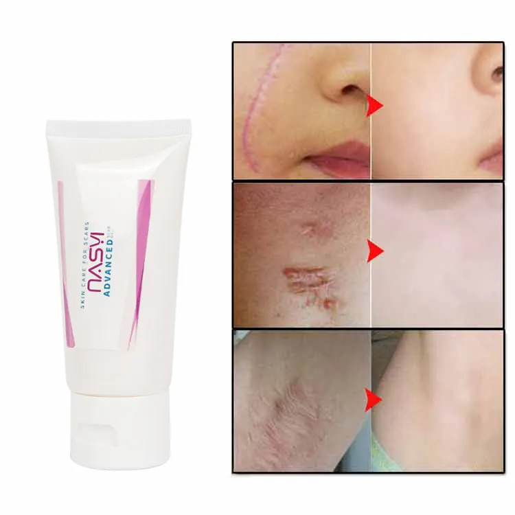 Private Label Best Effective Scar Creams Acne Silicone Scars Stretch Marks Removal Face Scar Gel