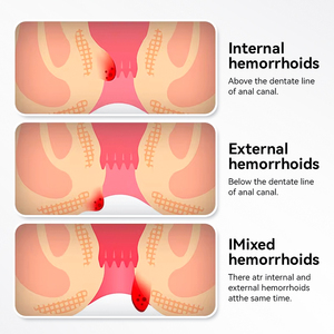 ครีมสมุนไพรบรรเทาอาการริดสีดวงทวาร |   วังไทลิน ซูทติ้ง แคร์ สำหรับ<span class=keywords><strong>อาการ</strong></span>คันที่ทวารหนัก <span class=keywords><strong>ปวด</strong></span> และรอยแยก 20 กรัม - Product Image 3