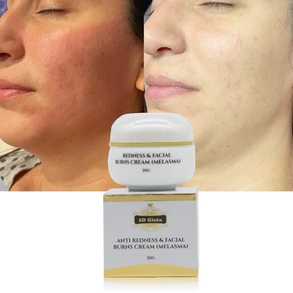 Forte efficace éclaircissement de la peau réduire les rougeurs brûlure visage visage blanchissant crème de tache de rousseur supprimer Melasma fondu foncé