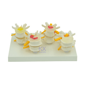Lesione della colonna lombare a quattro stadi modello anatomico per l'educazione medica - Product Image 6