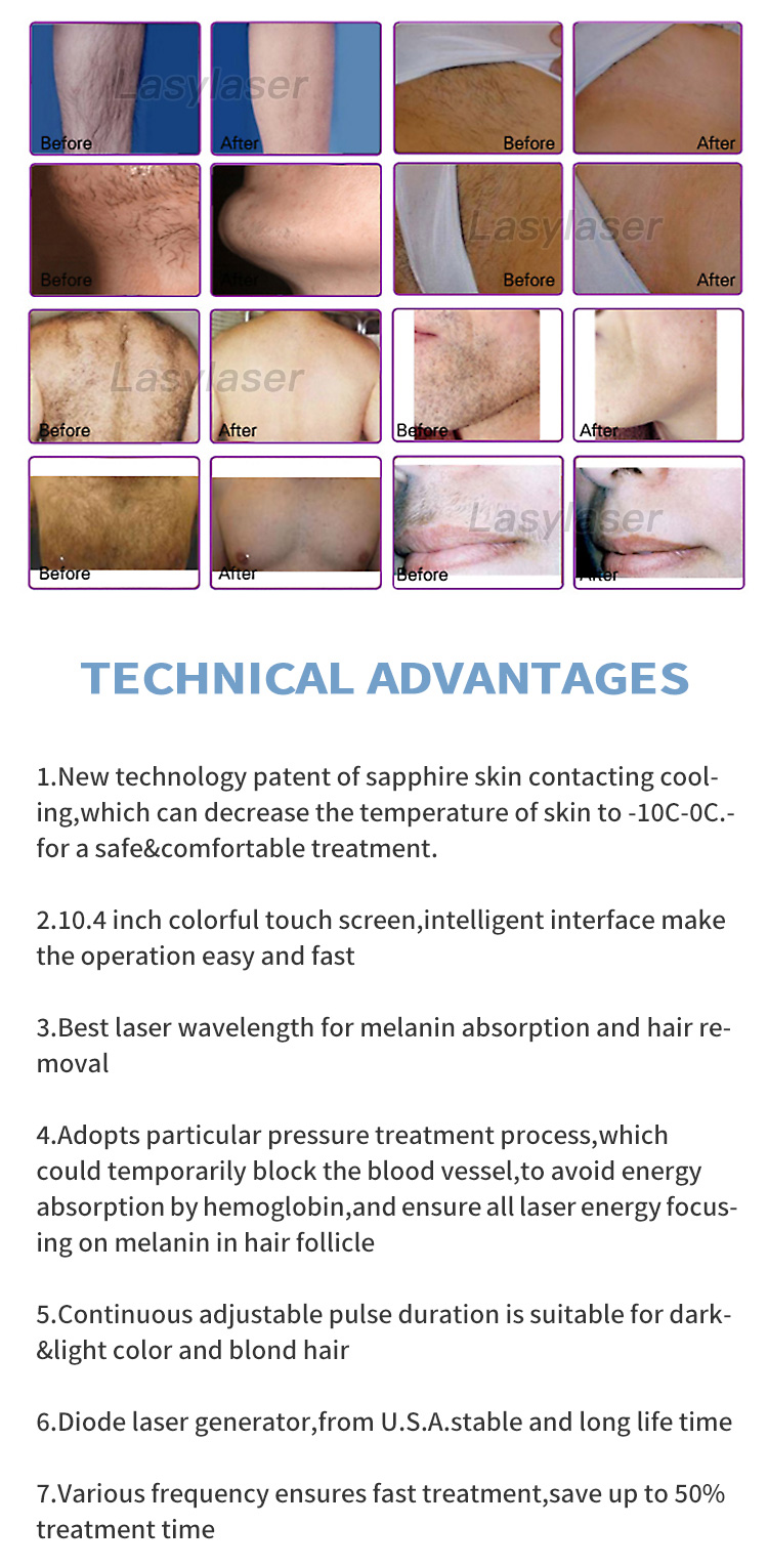 Diode laser 808nm epilator laser hair removal machine 755 808 1064 three wavelength laser hair removal machine beauty instrument