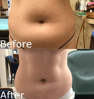Machine de liposuccion laser 980nm 1470nm endolaser de liposuccion vaser médical lifting lipolyse amincissant la machine