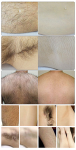 Máquina de depilación permanente con láser de 808nm, Bikini portátil, depilación indolora, depilación de hielo portátil para Dispositivo de salón de belleza - Product Image 5