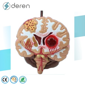 Modelo de Cerebro para Epilepsia Tipo Maniquí, Material PLA, para Hemorragia Cerebral, Malformación Arteriovenosa, Patología - Product Image 3