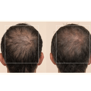 ETRUN ALISA Marque privée Sérum de croissance des cheveux à la biotine Réduit la perte Fournit une hydratation instantanée avec du cuir chevelu <span class=keywords><strong>Dermaroller</strong></span> - Product Image 5