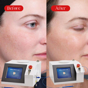 1470 نانومتر 980 نانومتر شفط الدهون بالليزر ديود فقدان الوزن ، Diodo 1470 نانومتر تحلل الدهون الوعائي الطبي - Product Image 4