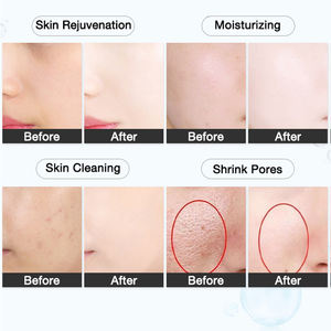 Machine de soins de la peau à usage domestique pour la tonification de la peau favorisant l'absorption cosmétique dispositif de cryo-électroporation D cool - Product Image 6