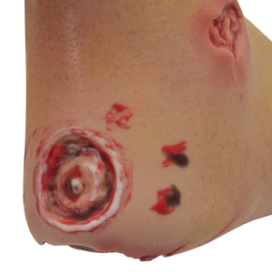 Modelo de Úlcera Diabética del Pie, Varias Etapas, Modelo de Enfermedad, Ciencia Médica - Product Image 6