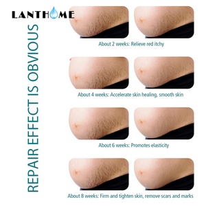 Eliminación de cicatrices de acné blanqueamiento facial embarazo nutrir cuerpo crema de piel posparto - Product Image 4