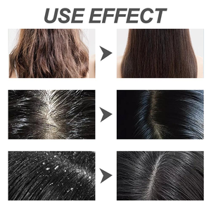 Label pribadi kulit kepala negara, <span class=keywords><strong>Psoriasis</strong></span> bubuk Lyophilized asam salisilat folikulitis minyak seboroic Dermatitis perawatan kulit kepala D - Product Image 4