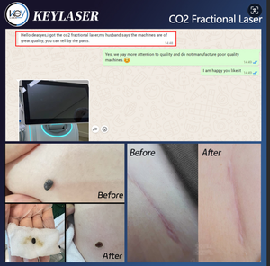 Máquina Quirúrgica Láser de CO2 Fraccional Estacionaria de Alta Potencia de 10600 nm de Uso Clínico para el Tratamiento del Acné y el Rejuvenecimiento de la Piel - Product Image 4
