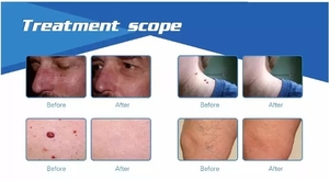 Máquina láser portátil de eliminación de vasos sanguíneos <span class=keywords><strong>vasculares</strong></span> de araña de 980nm, equipo de piel, máquina de belleza láser - Product Image 5