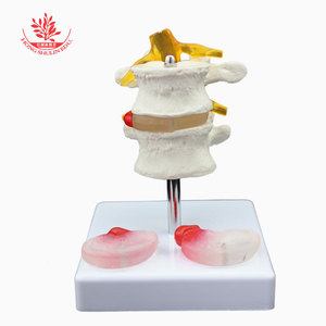 Modelo patológico de columna lumbar FRT038: Modelo humano de dos vértebras lumbares y dos discos intervertebrales enfermos con lesiones lumbares - Product Image 2