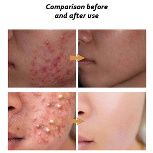 Set Professionale per la Cura del Viso 5D Gluta, Crema <span class=keywords><strong>Anti</strong></span> <span class=keywords><strong>Acne</strong></span> Forte ed Efficace, Siero per Rimuovere <span class=keywords><strong>Acne</strong></span> e Brufoli - Product Image 5